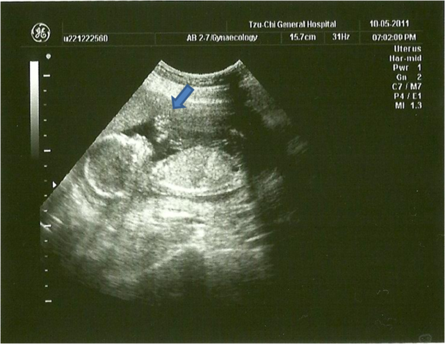 100年4~5月：懷孕邁入4個月，性別揭曉【12W~15W】 - 雨立今=霠